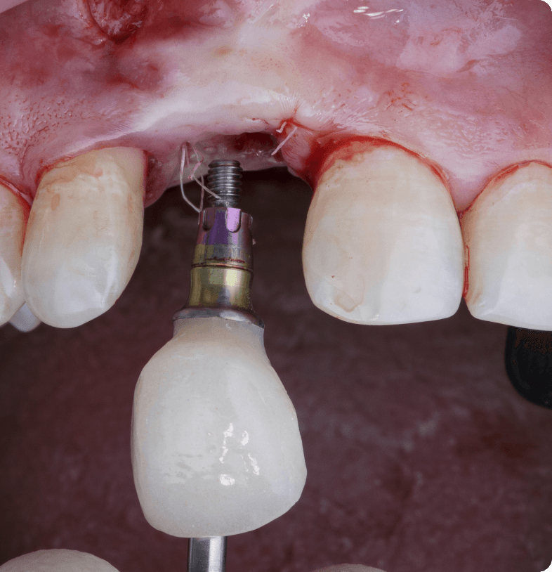 Dental Crown Types